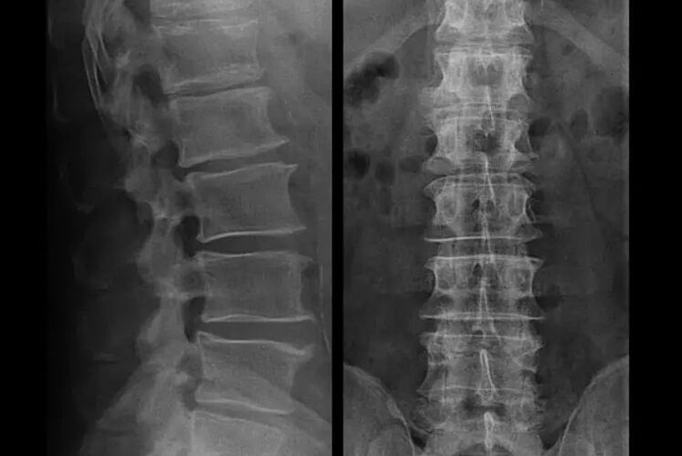 osteocondroza la radiografie