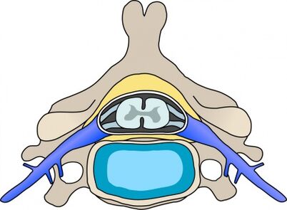 Protabius în vertebră cu osteocondroză cervicală